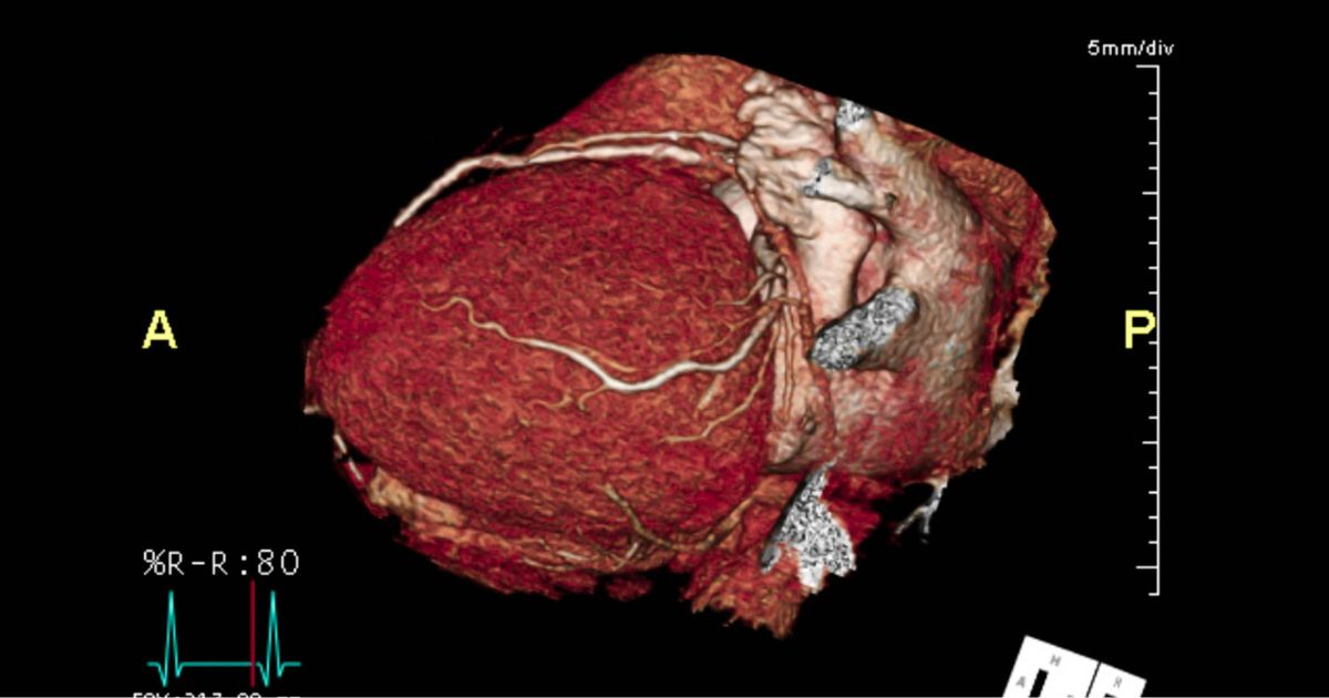 Αξονική Στεφανιογραφία